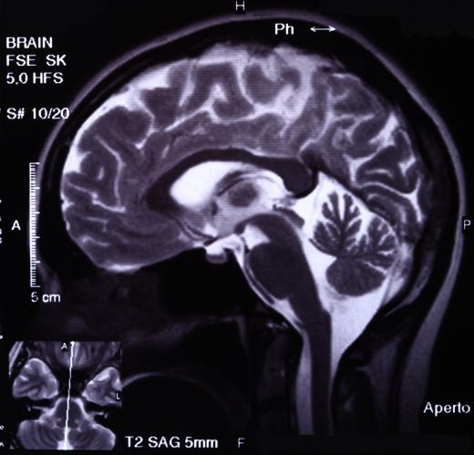 Functional MRIs allow doctors to track blood flow in the brain for a better picture of not just the structures but the functionality.