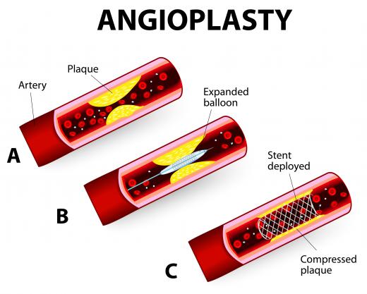 Platelet inhibitors are often administered intravenously during angioplasty.