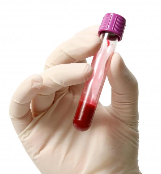 A simple blood test can be used to determine acid phosphatase levels.