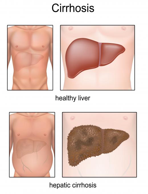 A number of liver conditions, including cirrhosis, can cause high levels of alkaline phosphatase.