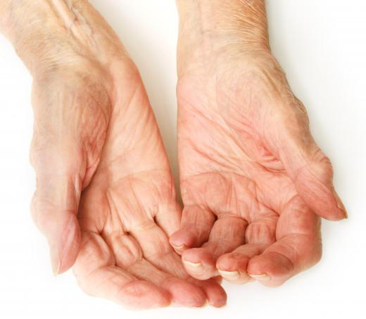 Immunosuppressive drugs can be part of a treatment for rheumatoid arthritis.