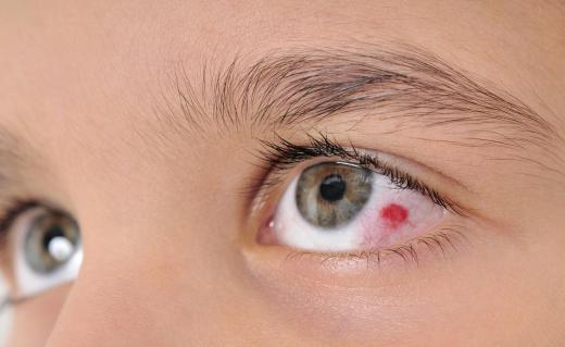 Exposure to contaminated water may cause an eye infection known as acanthamoeba keratitis.