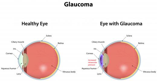 A polarimeter can help track degenerative eye conditions like glaucoma.