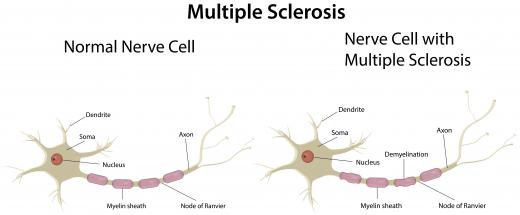 Multiple sclerosis is marked by the degredation of nerve cells' myelin sheath.