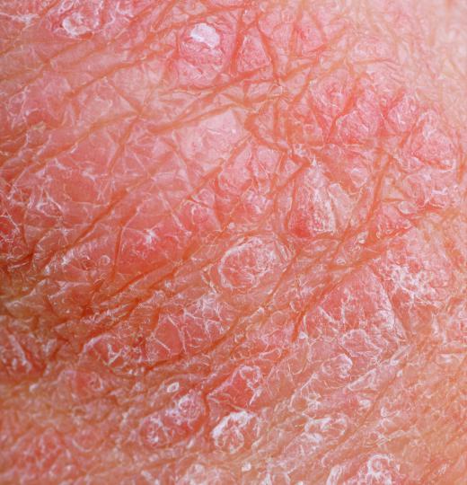 Resorcinol is commonly used to treat eczema.