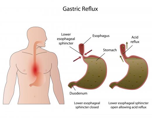 The lower esophageal sphincter sometimes fails to keep stomach acid from moving into the esophagus, a condition known as acid reflux.