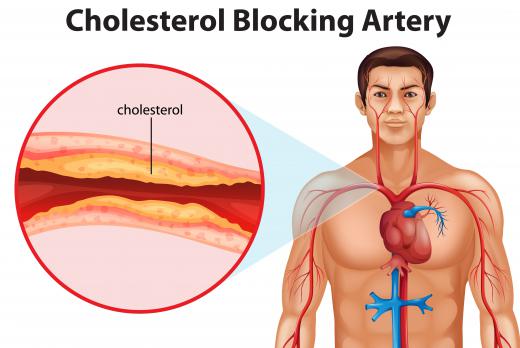 Chylomicrons help transport triglycerides, which in high levels can cause health problems.