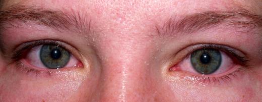 Xylene can cause eye irritation.