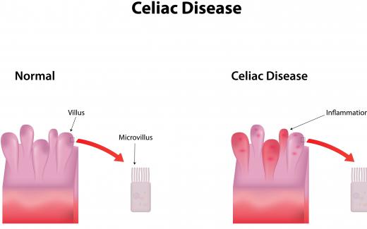 The actin antibody is associated with Celiac disease.