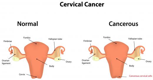 HPV, which is closely linked with cervical cancer, carries several known oncogenes.