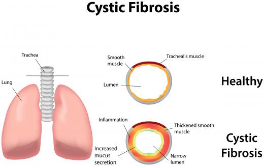 Cystic fibrosis is a common example of an autosomal recessive disease.