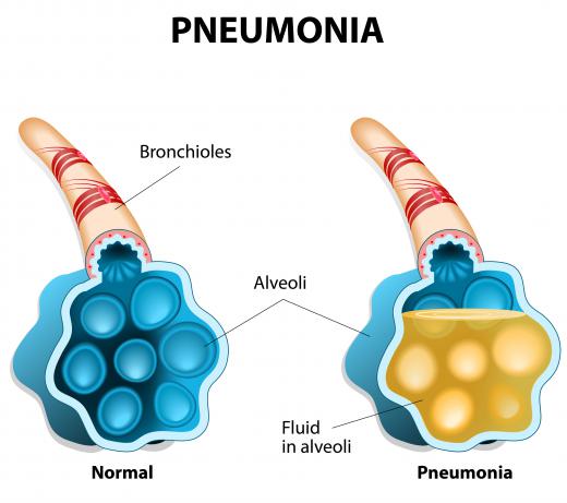 Both the inflammatory and anti-inflammatory actions of alveolar macrophages are involved with a person develops pneumonia.