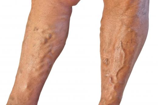 Anthocyanidins can be helpful in fighting varicose veins.