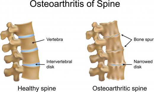 An illustration of a healthy spine and one with spinal osteoarthritis. Some studies suggest that chondroitin sulfate may help people with osteoarthritis of the spine.