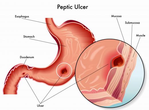 Stomach acid can damage stomach lining, which may result in a gastric ulcer.