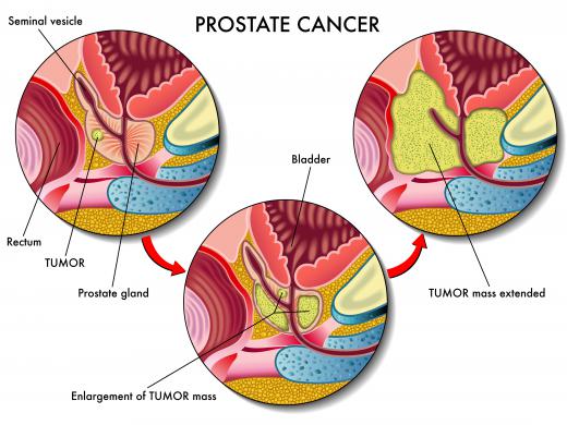 Prostate-specific antigen testing is commonly used to screen for prostate cancer.