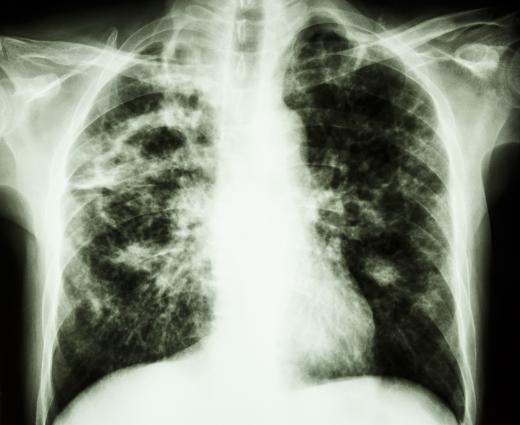 A positive antibody test is often followed by chest X-rays to check for signs of tuberculosis infection.